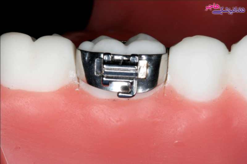بند ارتودنسی حلقه ای است که روی دندان آسیاب قرار می گیرد